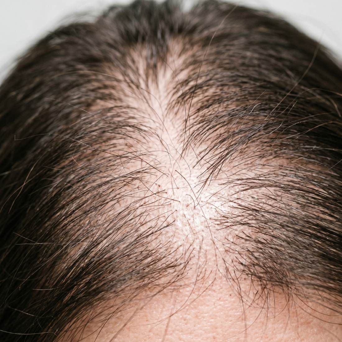 Hair Fall