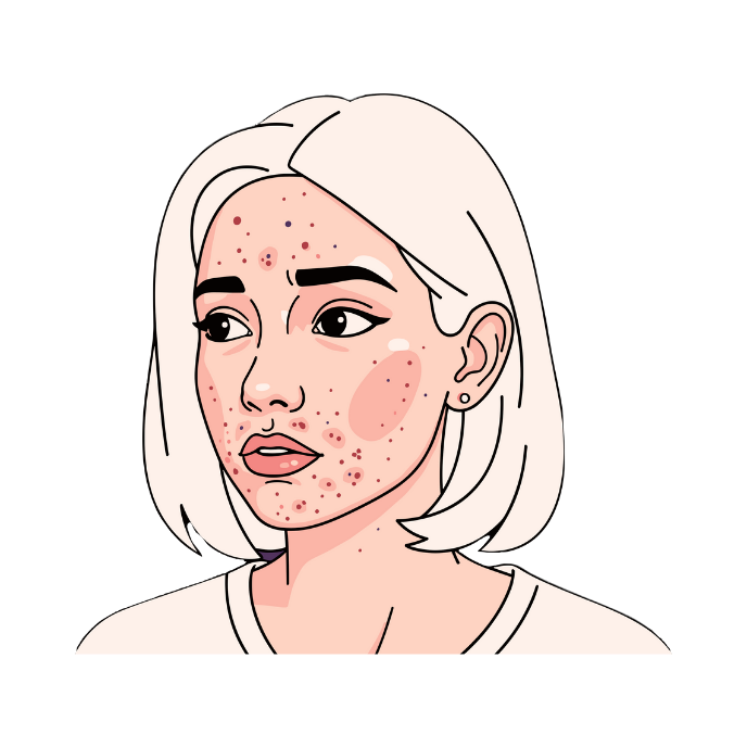 Cures Acne - Pimples